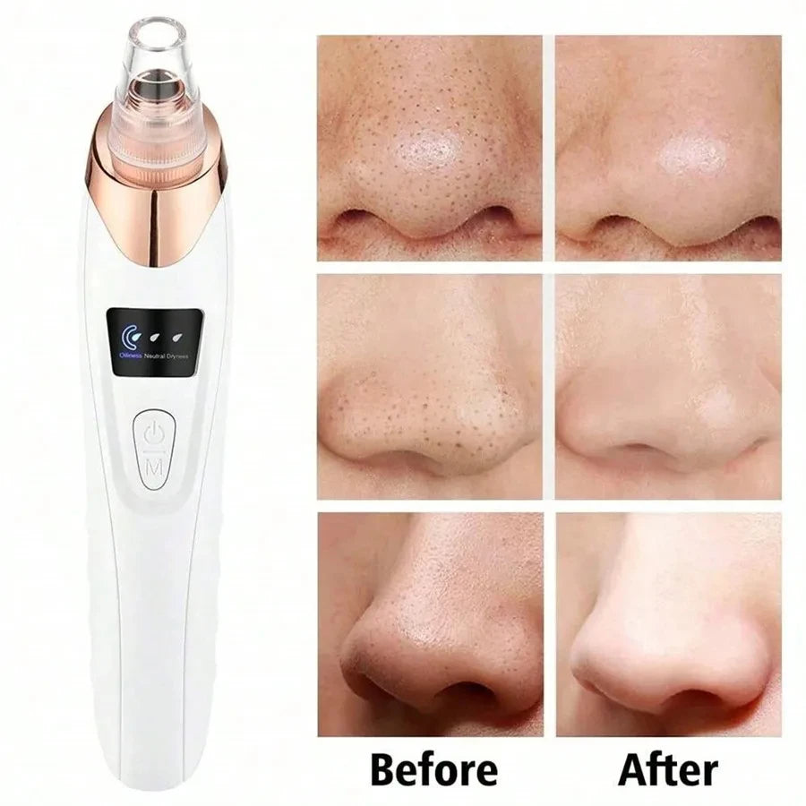 Electric Facial Blackhead Vacuum Remover – Deep Pore Cleansing Tool for Skin Care & Pore Refining