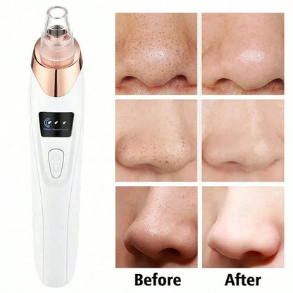 Electric Facial Blackhead Vacuum Remover – Deep Pore Cleansing Tool for Skin Care & Pore Refining
